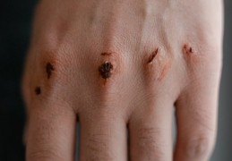 夢見家人受傷的 9 個夢境解釋：夢見兄弟姊妹受傷 、夢見配偶受傷
